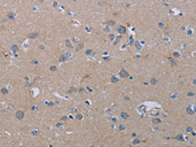 The image on the left is immunohistochemistry of paraffin-embedded Human brain  tissue using PDE4D Antibody(PDE4D Antibody) at dilution 1/20, on the right is treated with synthetic peptide. (Original magnification: ×200)Rabbit anti-Human PDE4D Polyclonal Antibody