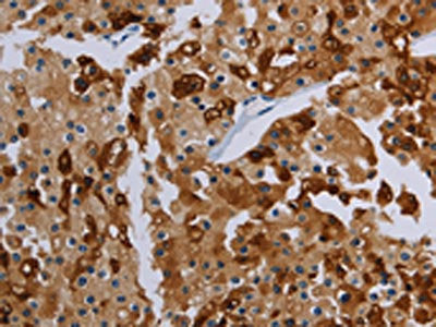 The image on the left is immunohistochemistry of paraffin-embedded Human prostate cancer tissue using the antibody Antibody) at dilution 1/20, on the right is treated with synthetic peptide. (Original magnification: ×200)Rabbit anti-Human PDE4D Polyclonal Antibody