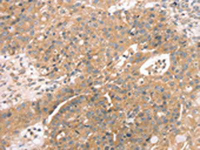 The image on the left is immunohistochemistry of paraffin-embedded Human breast cancer tissue using STX10 Antibody(STX10 Antibody) at dilution 1/45, on the right is treated with fusion protein. (Original magnification: ×200)Rabbit anti-Human STX10 Polyclonal Antibody