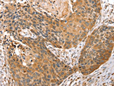 The image on the left is immunohistochemistry of paraffin-embedded Human esophagus cancer tissue using the antibody Antibody) at dilution 1/45, on the right is treated with fusion protein. (Original magnification: ×200)Rabbit anti-Human STX10 Polyclonal Antibody
