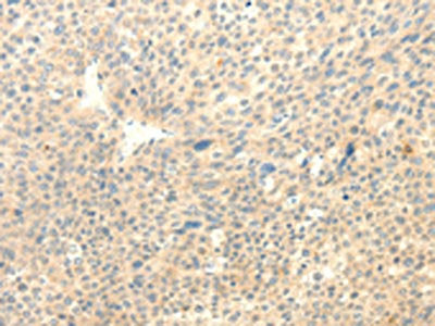The image on the left is immunohistochemistry of paraffin-embedded Human liver cancer tissue using TRAF6 Antibody(TRAF6 Antibody) at dilution 1/15, on the right is treated with fusion protein. (Original magnification: ×200)Rabbit anti-Human TRAF6 Polyclonal Antibody