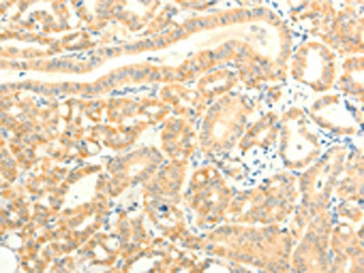 The image on the left is immunohistochemistry of paraffin-embedded Human thyroid cancer tissue using the antibody Antibody) at dilution 1/15, on the right is treated with fusion protein. (Original magnification: ×200)Rabbit anti-Human TRAF6 Polyclonal Antibody