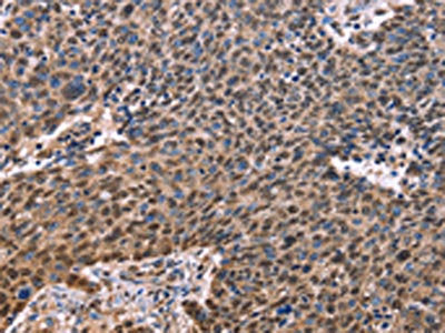 The image on the left is immunohistochemistry of paraffin-embedded Human ovarian cancer tissue using EVC2 Antibody(EVC2 Antibody) at dilution 1/40, on the right is treated with synthetic peptide. (Original magnification: ×200)Rabbit anti-Human EVC2 Polyclonal Antibody