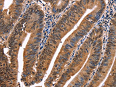 The image on the left is immunohistochemistry of paraffin-embedded Human colon cancer tissue using the antibody Antibody) at dilution 1/40, on the right is treated with synthetic peptide. (Original magnification: ×200)Rabbit anti-Human EVC2 Polyclonal Antibody