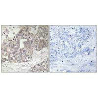Immunohistochemistry analysis of paraffin-embedded human liver carcinoma tissue using ATG4C antibody.
