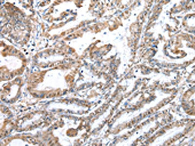The image on the left is immunohistochemistry of paraffin-embedded Human esophagus cancer tissue using WDR5 Antibody(WDR5 Antibody) at dilution 1/20, on the right is treated with fusion protein. (Original magnification: ×200)Rabbit anti-Human WDR5 Polyclonal Antibody