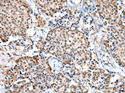 The image on the left is immunohistochemistry of paraffin-embedded Human breast cancer tissue using the antibody Antibody) at dilution 1/20, on the right is treated with fusion protein. (Original magnification: ×200)Rabbit anti-Human WDR5 Polyclonal Antibody