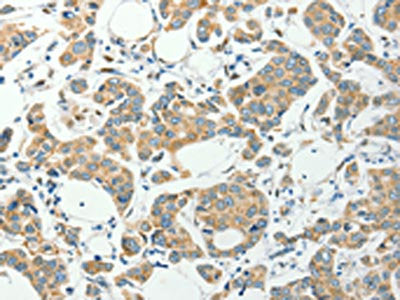 The image on the left is immunohistochemistry of paraffin-embedded Human colon cancer tissue using PFDN6 Antibody(PFDN6 Antibody) at dilution 1/35, on the right is treated with synthetic peptide. (Original magnification: ×200)Rabbit anti-Human PFDN6 Polyclonal Antibody