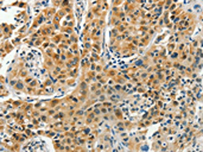 The image on the left is immunohistochemistry of paraffin-embedded Human lung cancer tissue using the antibody Antibody) at dilution 1/35, on the right is treated with synthetic peptide. (Original magnification: ×200)Rabbit anti-Human PFDN6 Polyclonal Antibody