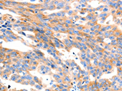 The image on the left is immunohistochemistry of paraffin-embedded Human ovarian cancer tissue using MAP2K2 Antibody(MAP2K2 Antibody) at dilution 1/100, on the right is treated with synthetic peptide. (Original magnification: ×200)