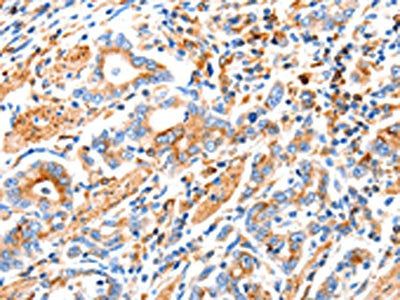 The image on the left is immunohistochemistry of paraffin-embedded Human gastic cancer tissue using the antibody Antibody) at dilution 1/100, on the right is treated with synthetic peptide. (Original magnification: ×200)
