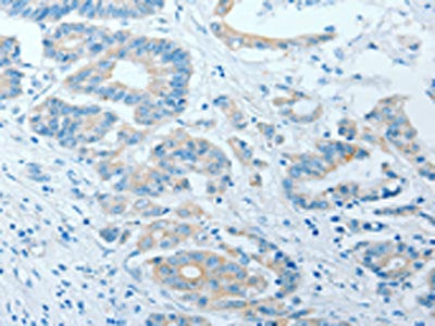The image on the left is immunohistochemistry of paraffin-embedded Human colon cancer tissue using AKAP7 Antibody(AKAP7 Antibody) at dilution 1/15, on the right is treated with fusion protein. (Original magnification: ×200)Rabbit anti-Human AKAP7 Polyclonal Antibody