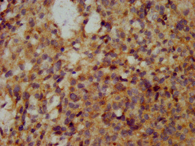 IHC image of WFDC2 Antibody diluted at 1:200 and staining in paraffin-embedded human ovarian cancer performed on a Leica BondTM system. After dewaxing and hydration, antigen retrieval was mediated by high pressure in a citrate buffer (pH 6.0). Section was blocked with 10% normal goat serum 30min at RT. Then primary antibody (1% BSA) was incubated at 4°C overnight. The primary is detected by a biotinylated secondary antibody and visualized using an HRP conjugated SP system.Rabbit anti-Human WFDC2 Polyclonal Antibody
