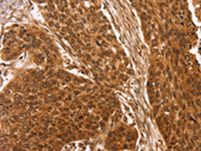 The image on the left is immunohistochemistry of paraffin-embedded Human esophagus cancer tissue using the antibody Antibody) at dilution 1/25, on the right is treated with synthetic peptide. (Original magnification: ×200)