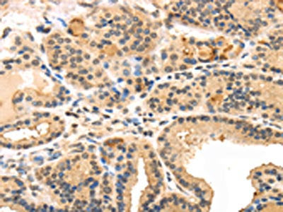 The image on the left is immunohistochemistry of paraffin-embedded Human thyroid cancer tissue using TUSC5 Antibody(TUSC5 Antibody) at dilution 1/40, on the right is treated with synthetic peptide. (Original magnification: ×200)Rabbit anti-Human TUSC5 Polyclonal Antibody