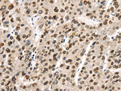 The image on the left is immunohistochemistry of paraffin-embedded Human liver cancer tissue using the antibody Antibody) at dilution 1/40, on the right is treated with synthetic peptide. (Original magnification: ×200)Rabbit anti-Human TUSC5 Polyclonal Antibody