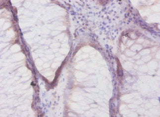 Immunohistochemistry of paraffin-embedded human colon cancer using the antibody at dilution of 1:50Rabbit anti-Human DEFB1 Polyclonal Antibody