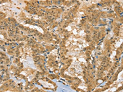 The image on the left is immunohistochemistry of paraffin-embedded Human thyroid cancer tissue using the antibody Antibody) at dilution 1/40, on the right is treated with fusion protein. (Original magnification: ×200)Rabbit anti-Human PSMC1 Polyclonal Antibody