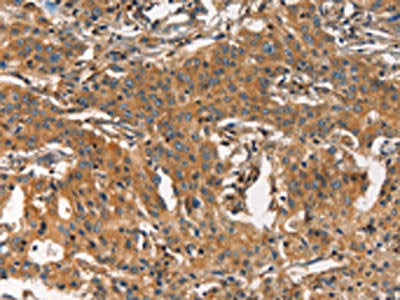 The image on the left is immunohistochemistry of paraffin-embedded Human gastric cancer tissue using ARPC2 Antibody(ARPC2 Antibody) at dilution 1/30, on the right is treated with synthetic peptide. (Original magnification: ×200)Rabbit anti-Human ARPC2 Polyclonal Antibody