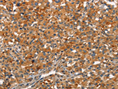 The image on the left is immunohistochemistry of paraffin-embedded Human thyroid cancer tissue using the antibody Antibody) at dilution 1/30, on the right is treated with synthetic peptide. (Original magnification: ×200)Rabbit anti-Human ARPC2 Polyclonal Antibody