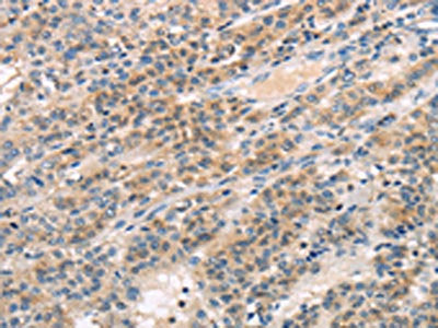 The image on the left is immunohistochemistry of paraffin-embedded Human liver cancer tissue using TTC23 Antibody(TTC23 Antibody) at dilution 1/30, on the right is treated with fusion protein. (Original magnification: ×200)Rabbit anti-Human TTC23 Polyclonal Antibody