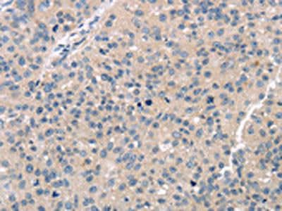 The image on the left is immunohistochemistry of paraffin-embedded Human breast cancer tissue using the antibody Antibody) at dilution 1/30, on the right is treated with fusion protein. (Original magnification: ×200)Rabbit anti-Human TTC23 Polyclonal Antibody