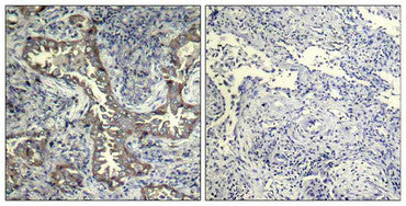 Immunohistochemical analysis of paraffin-embedded human breast carcinoma tissue using BAD (Phospho-Ser112) Antibody (left) or the same antibody preincubated with blocking peptide (right).