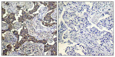 Immunohistochemical analysis of paraffin-embedded human Lung carcinoma tissue using BAD (Phospho-Ser112) Antibody (left) or the same antibody preincubated with blocking peptide (right).