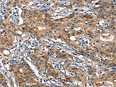 The image on the left is immunohistochemistry of paraffin-embedded Human gastric cancer tissue using ANP32C Antibody(ANP32C Antibody) at dilution 1/15, on the right is treated with synthetic peptide. (Original magnification: ×200)Rabbit anti-Human ANP32C Polyclonal Antibody