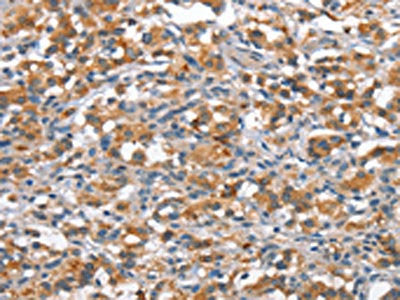 The image on the left is immunohistochemistry of paraffin-embedded Human thyroid cancer tissue using the antibody Antibody) at dilution 1/15, on the right is treated with synthetic peptide. (Original magnification: ×200)Rabbit anti-Human ANP32C Polyclonal Antibody