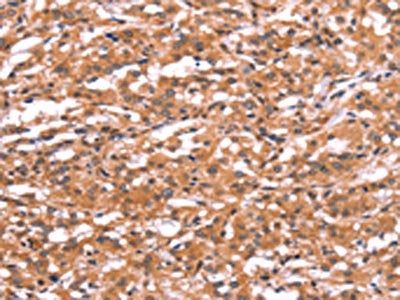 The image on the left is immunohistochemistry of paraffin-embedded Human thyroid cancer tissue using the antibody Antibody) at dilution 1/30, on the right is treated with synthetic peptide. (Original magnification: ×200)Rabbit anti-Human GABRA1 Polyclonal Antibody