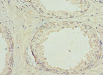 Immunohistochemistry of paraffin-embedded human prostate cancer using PYGB Antibody at dilution of 1:100Rabbit anti-Human PYGB Polyclonal Antibody