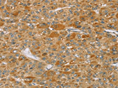The image on the left is immunohistochemistry of paraffin-embedded Human liver cancer tissue using the antibody Antibody) at dilution 1/40, on the right is treated with synthetic peptide. (Original magnification: ×200)Rabbit anti-Human TP53I11 Polyclonal Antibody