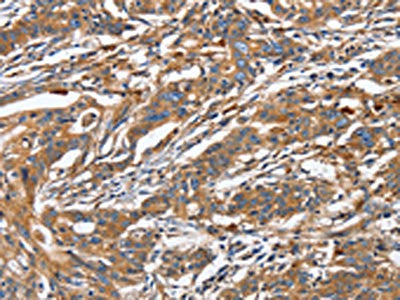 The image on the left is immunohistochemistry of paraffin-embedded Human gastric cancer tissue using GNA13 Antibody(GNA13 Antibody) at dilution 1/30, on the right is treated with fusion protein. (Original magnification: ×200)Rabbit anti-Human GNA13 Polyclonal Antibody