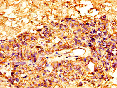 IHC image of the antibody diluted at 1:300 and staining in paraffin-embedded human ovarian cancer performed on a Leica BondTM system. After dewaxing and hydration, antigen retrieval was mediated by high pressure in a citrate buffer (pH 6.0). Section was blocked with 10% normal goat serum 30min at RT. Then primary antibody (1% BSA) was incubated at 4°C overnight. The primary is detected by a biotinylated secondary antibody and visualized using an HRP conjugated SP system.Rabbit anti-Human MSLN Polyclonal Antibody