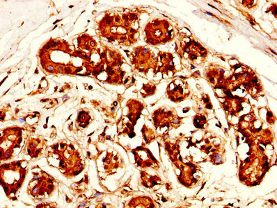 IHC image of MSLN Antibody diluted at 1:300 and staining in paraffin-embedded human breast cancer performed on a Leica BondTM system. After dewaxing and hydration, antigen retrieval was mediated by high pressure in a citrate buffer (pH 6.0). Section was blocked with 10% normal goat serum 30min at RT. Then primary antibody (1% BSA) was incubated at 4°C overnight. The primary is detected by a biotinylated secondary antibody and visualized using an HRP conjugated SP system.Rabbit anti-Human MSLN Polyclonal Antibody