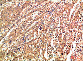 Immunohistochemical analysis of paraffin-embedded Human Lung Carcinoma Tissue using JNK2 Rabbit  pAb diluted at 1:200