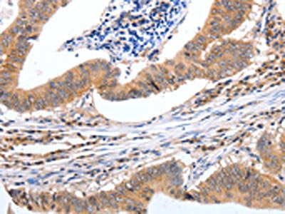 The image on the left is immunohistochemistry of paraffin-embedded Human colon cancer tissue using PGC Antibody(PGC Antibody) at dilution 1/20, on the right is treated with fusion protein. (Original magnification: ×200)Rabbit anti-Human PGC Polyclonal Antibody