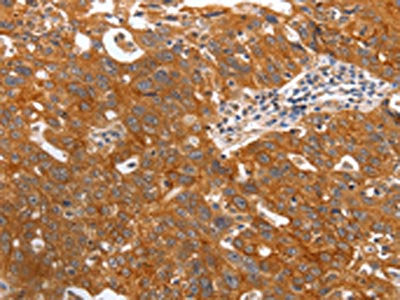 The image on the left is immunohistochemistry of paraffin-embedded Human ovarian cancer tissue using the antibody Antibody) at dilution 1/20, on the right is treated with fusion protein. (Original magnification: ×200)Rabbit anti-Human PGC Polyclonal Antibody