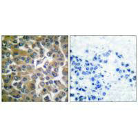 Immunohistochemical analysis of paraffin-embedded human breast carcinoma tissue using FAP-1 antibody.Rabbit anti-Human FAP Polyclonal Antibody