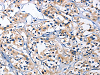 The image on the left is immunohistochemistry of paraffin-embedded Human thyroid cancer tissue using the antibody Antibody) at dilution 1/30, on the right is treated with fusion protein. (Original magnification: ×200)