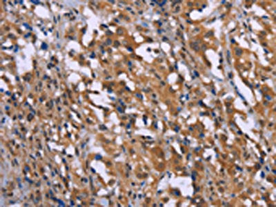 The image on the left is immunohistochemistry of paraffin-embedded Human thyroid cancer tissue using GAD1 Antibody(GAD1 Antibody) at dilution 1/40, on the right is treated with synthetic peptide. (Original magnification: ×200)Rabbit anti-Human GAD1 Polyclonal Antibody