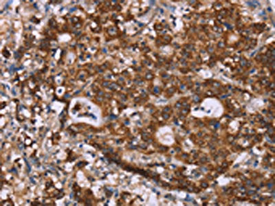 The image on the left is immunohistochemistry of paraffin-embedded Human gastic cancer tissue using the antibody Antibody) at dilution 1/40, on the right is treated with synthetic peptide. (Original magnification: ×200)Rabbit anti-Human GAD1 Polyclonal Antibody