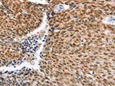 The image on the left is immunohistochemistry of paraffin-embedded Human lung cancer tissue using IRF6 Antibody(IRF6 Antibody) at dilution 1/50, on the right is treated with fusion protein. (Original magnification: ×200)