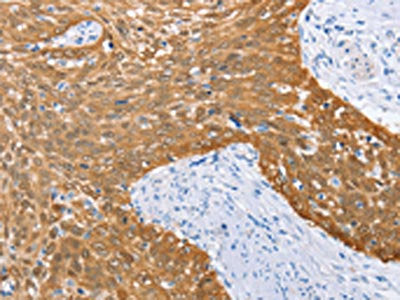 The image on the left is immunohistochemistry of paraffin-embedded Human cervical cancer tissue using the antibody Antibody) at dilution 1/50, on the right is treated with fusion protein. (Original magnification: ×200)