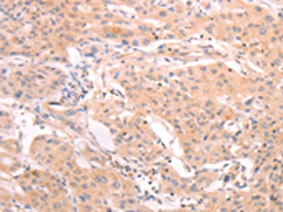 The image on the left is immunohistochemistry of paraffin-embedded Human lung cancer tissue using INA Antibody(INA Antibody) at dilution 1/25, on the right is treated with synthetic peptide. (Original magnification: ×200)Rabbit anti-Human INA Polyclonal Antibody