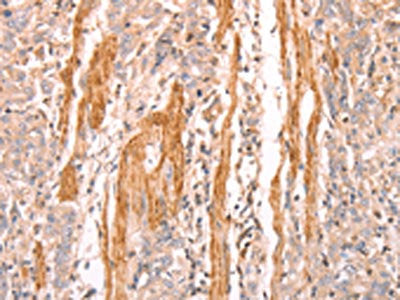The image on the left is immunohistochemistry of paraffin-embedded Human gastic cancer tissue using the antibody Antibody) at dilution 1/25, on the right is treated with synthetic peptide. (Original magnification: ×200)Rabbit anti-Human INA Polyclonal Antibody
