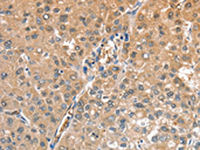 The image on the left is immunohistochemistry of paraffin-embedded Human liver cancer tissue using CIAPIN1 Antibody(CIAPIN1 Antibody) at dilution 1/60, on the right is treated with fusion protein. (Original magnification: ×200)Rabbit anti-Human CIAPIN1 Polyclonal Antibody