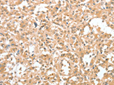 The image on the left is immunohistochemistry of paraffin-embedded Human thyroid cancer tissue using the antibody Antibody) at dilution 1/60, on the right is treated with fusion protein. (Original magnification: ×200)Rabbit anti-Human CIAPIN1 Polyclonal Antibody