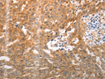 The image on the left is immunohistochemistry of paraffin-embedded Human ovarian cancer tissue using NQO1 Antibody(NQO1 Antibody) at dilution 1/25, on the right is treated with synthetic peptide. (Original magnification: ×200)Rabbit anti-Human NQO1 Polyclonal Antibody